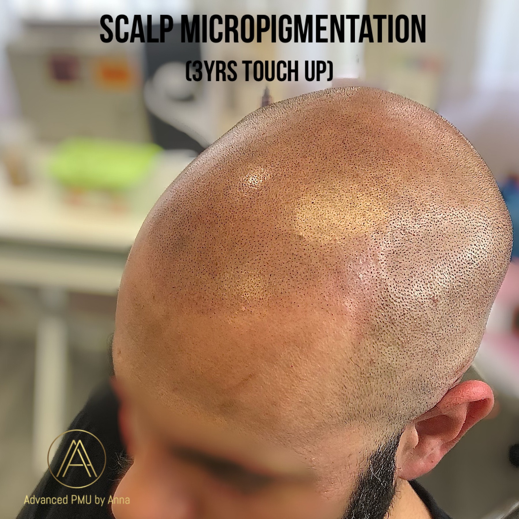 Scalp Micropigmentation Training Certification in LA NY and Seoul